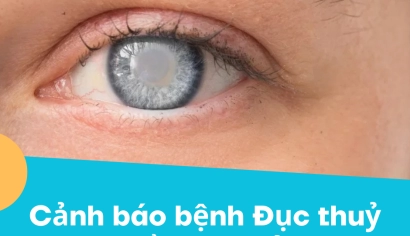 Bệnh đục thủy tinh thể trẻ hóa do lối sống hiện đại | BV Mắt Miền Đông