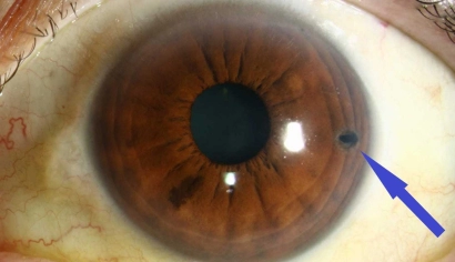 Cắt mống mắt chu biên bằng laser – Giải pháp điều trị glaucoma góc đóng hiệu quả