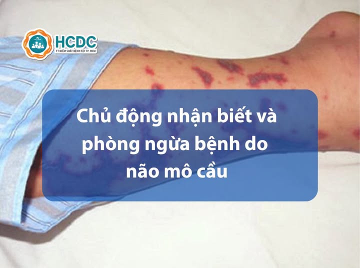 Bệnh não mô cầu 