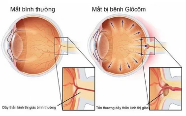 Bệnh Viện Mắt Miền Đông hưởng ứng tuần lễ GLAUCOMA thế giới với chủ đề: Đoàn kết vì một thế giới không có bệnh Glaucoma