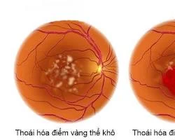 Hình ảnh thoái hóa điểm vàng